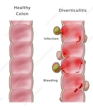Diverticulitis and Noraml.jpg